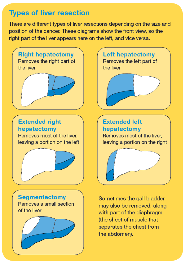 Types of liver resection